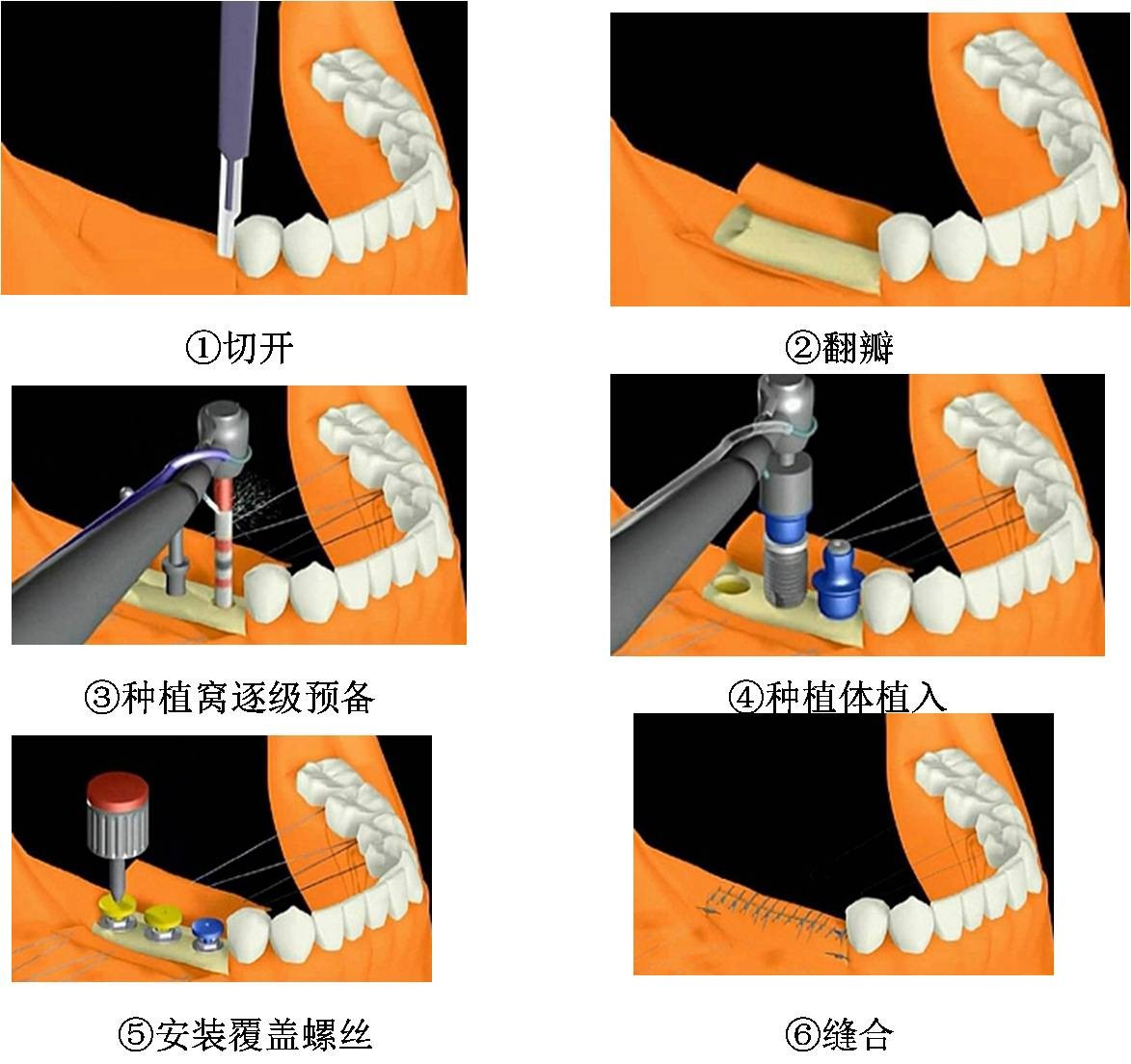无牙颌种植上部修复-瑞佳义齿