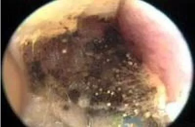 耳部真菌感染图片