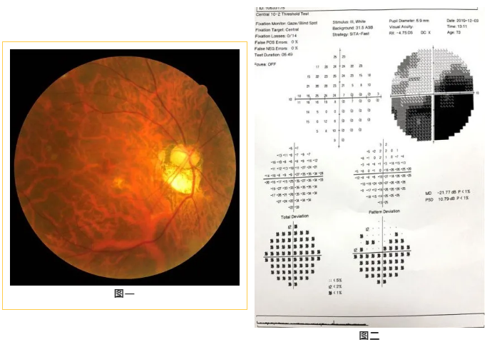 直流电刺激术治疗视神经萎缩患者视野缺损
