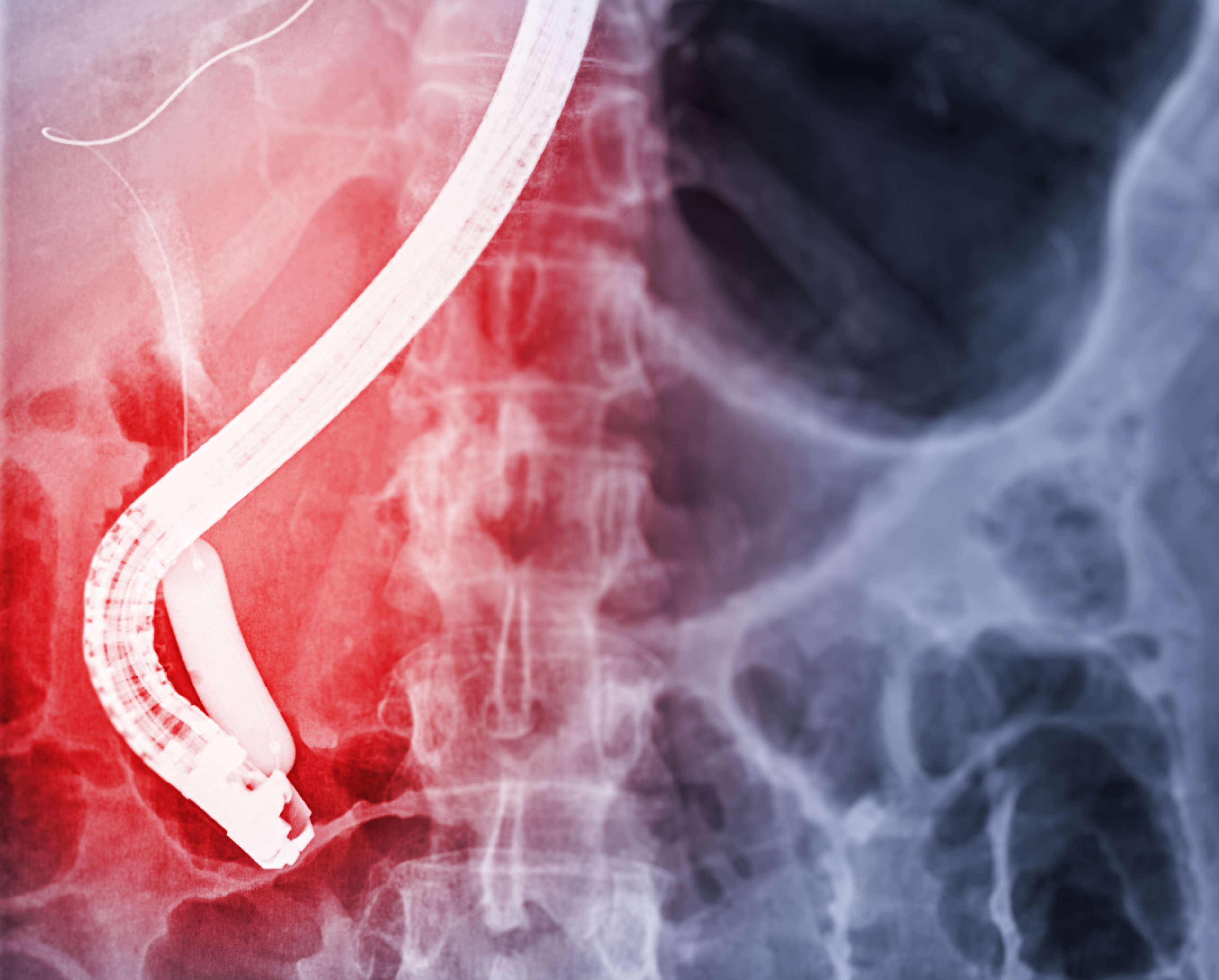 千库网_医生在现代手术室内进行 ERCP 和腹腔镜胆囊切除术后内窥镜的 X 射线图像。_摄影图编号15053027_爱奇艺.jpg