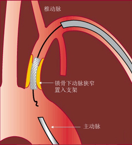 锁骨下动脉延续图片