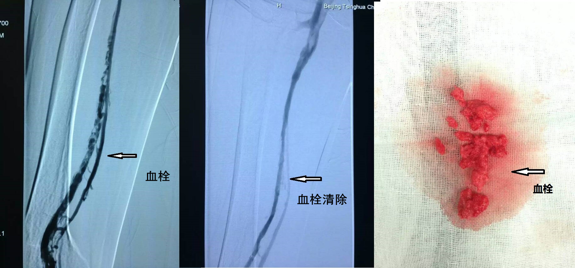 不容忽视的髂静脉压迫综合征 -西安凤城医院[官网] 急救电话：029-86530966