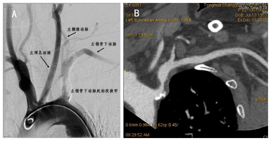 锁骨下动脉盗血图片图片