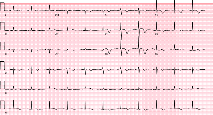 前间壁心梗心电图表现图片