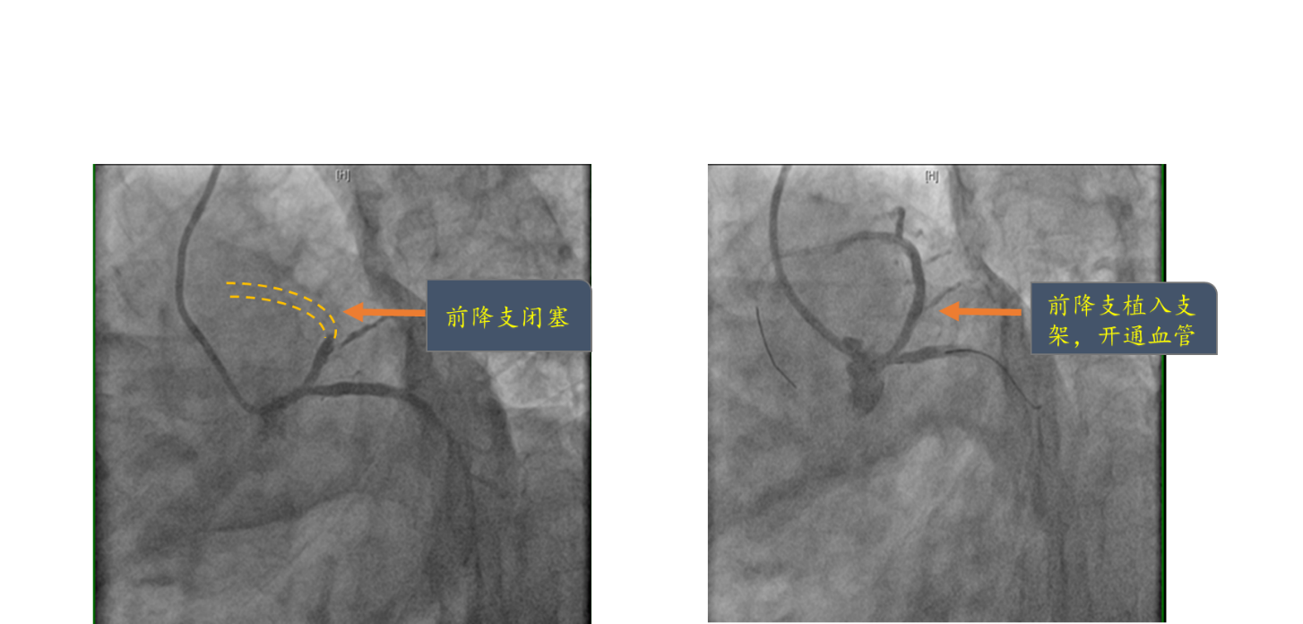 左前降支狭窄图片展示图片