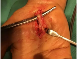 透析患者的"鼠标手"