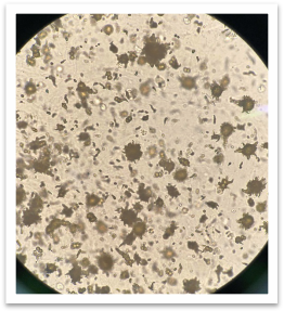 尿酸结晶图片显微镜图片