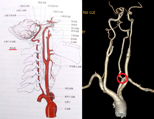 脊髓前后动脉图片