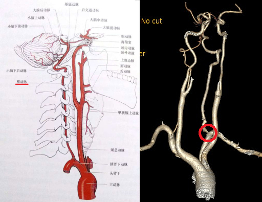 椎动脉沟环位置图片图片