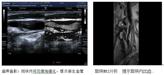 颈动脉斑块精准评估与规范化治疗——清华长庚医院血管外科开展颈动脉斑块专科门诊