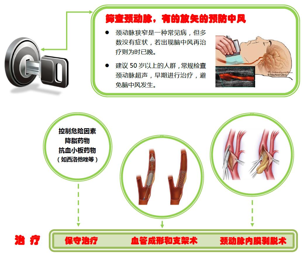 颈动脉斑块精准评估与规范化治疗——清华长庚医院血管外科开展颈动脉