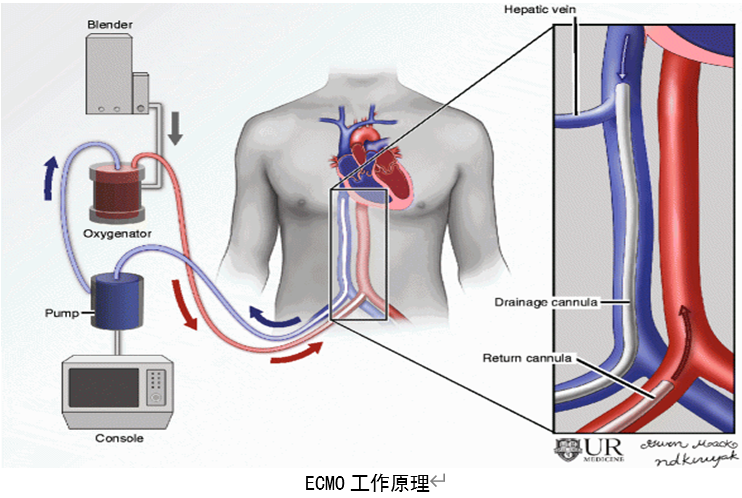 ecmo的工作原理图片