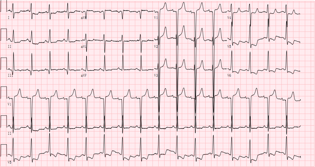主动脉瓣狭窄心电图图片