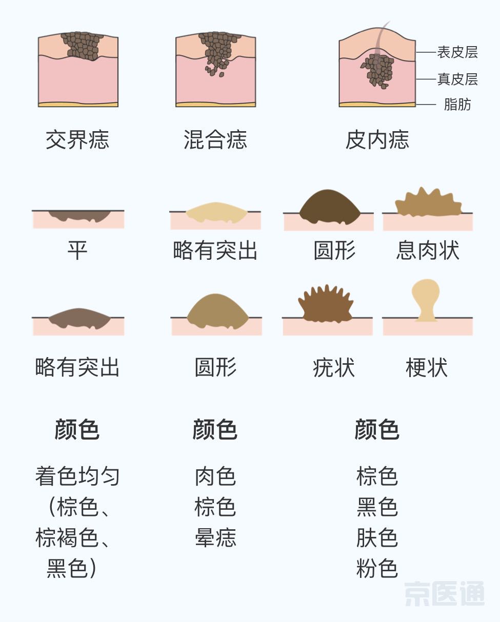 就医指导   痣一般不需要治疗,日常不要反复刺激,搔抓痣及周围皮肤