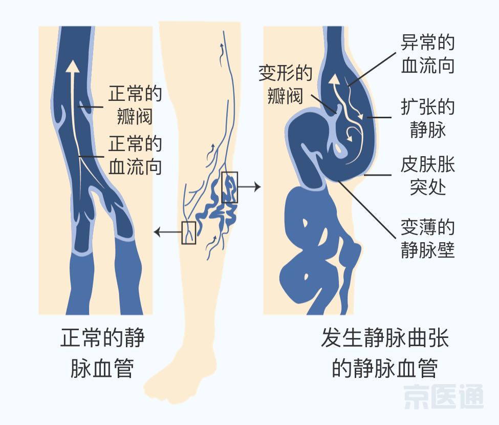 下肢静脉曲张-健康教育-清华大学附属北京清华长庚医院血管外科