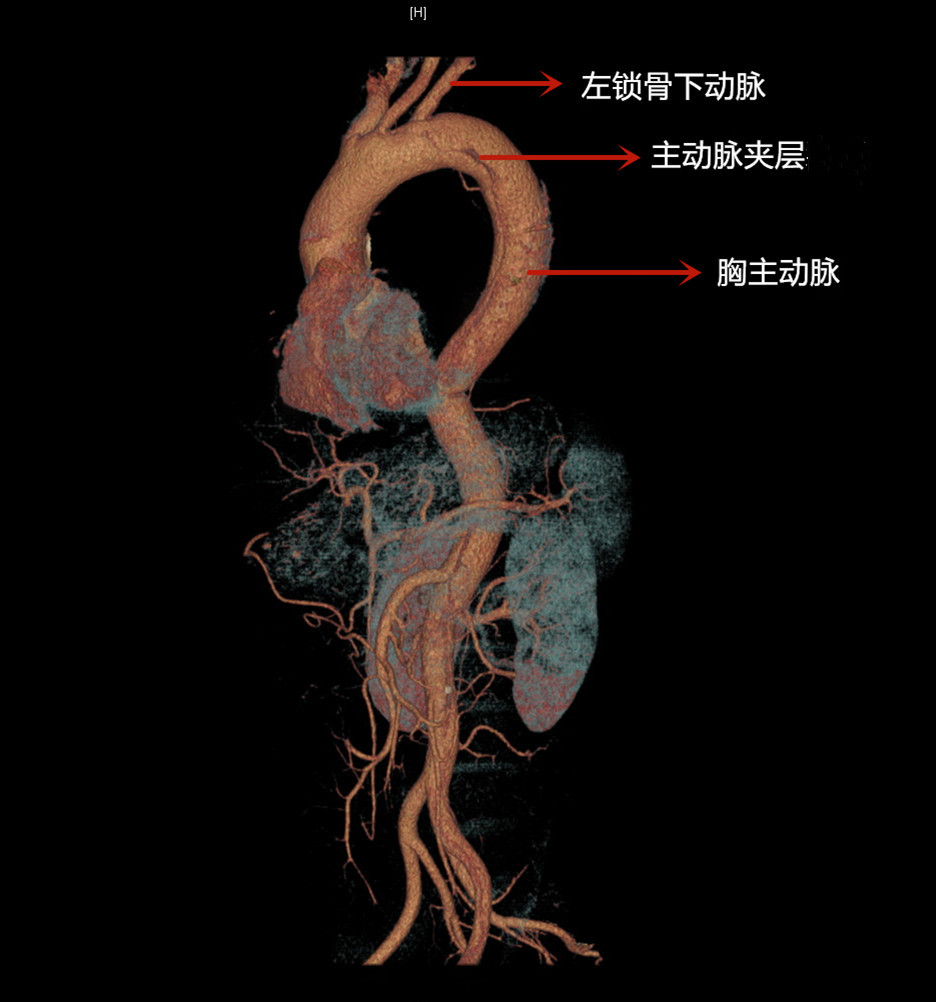 主动脉人造血管图片图片